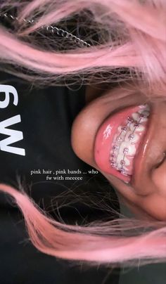 Braces With Lip Gloss, Braces For Black Women, Pink And Black Braces, Pink Braces Black Women, Smiley Piercing With Braces, Pink Braces Aesthetic, Light Pink Braces, Pretty Braces