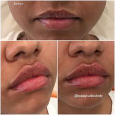 Dermal Fillers Lips, Ethnic Rhinoplasty, Skin Anatomy, Heart Shaped Lips, Double Nose Piercing, Face Fillers, Botox Lips