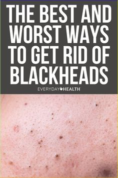 What Causes Blackheads?
How to Prevent Blackheads on Your Skin
The Best Ways to Get Rid of Blackheads
The Worst Ways to Get Rid of Blackheads
Acne comes in many shapes, sizes, and colors — and sometimes, the skin condition doesn’t look like an obvious blemish at all.
Take blackheads, those pesky dark-colored gunk-filled spots. If you’ve ever tried squeezing one, you’ve probably found yourself facing down an angry bump instead and immediately regretted it. Diy Face Scrub For Blackheads, Stubborn Blackheads Removal, Best Skin Care Products For Blackheads, Best Way To Remove Blackheads, What Helps Get Rid Of Blackheads, How To Get Rid Of Stubborn Blackheads, Best Way To Get Rid Of Blackheads, How To Extract Blackheads, How To Remove Blackheads From Face