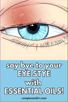 Home treatment is all that is needed for most styes! Learn how to treat an eye stye with natural home remedies here. This essential oil remedy for eye styes is effective and fast! Eye Relief Remedies, How To Get Rid Of Stye Eye, Natural Remedies For Stye Eye, How To Get Rid Of A Stye On Your Eyelid, How To Treat A Stye In Your Eye, Eye Stye Remedies How To Get Rid, Natural Stye Remedies, Home Remedy For Stye Eye, How To Heal A Stye Fast