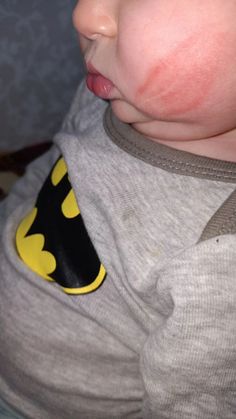 a baby with red and yellow spots on his face is wearing a batman bib