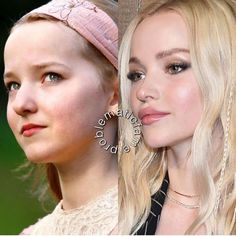 Dana on Instagram: “#DoveCameron appears to have a brow lift (and/or bleph) cheek filler, a nose job, lip filler, chin/jawline filler. I’ve posted her before…” Jawline Filler, Nose Fillers, Chin Filler, Bad Plastic Surgeries, Face Fillers, Botox Cosmetic, Cheek Fillers, Facial Contouring, Celebrity Plastic Surgery