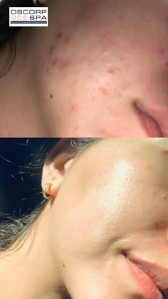 Tu si piel puede corregirse, mejorar notablemente hasta lucir sana y radiante: Pero es necesario llevar un régimen de Skin Care adaptado al Instante de tu piel con productos de calidad.  En Oscorp Spa, creemos en el poder de lo natural para revelar tu auténtica belleza. Por eso, nos enorgullecemos de ser un centro certificado de Biologique Recherche. Skin Facts, Physical Wellness, Love Photos, Feel Confident, Make You Feel, Feel Good, Health And Beauty, Spa, Acne