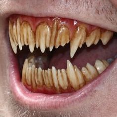 a close up of a man's teeth with tooth decay