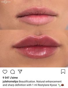 Good Lip Filler Pictures, Lip Blush And Filler, Lip Injections Inspiration, Sydney Sweeney Lips, Lip Injection Inspiration, Lip Filler 2ml, Perfect Lips Injections, .5 Lip Filler, Lip Filler On Small Lips