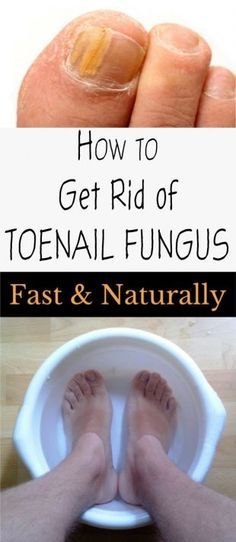 How to Get Rid of Toenail Fungus Fast and Naturally Toenail Fungus Essential Oils, Wine Making Kits, Fingernail Fungus, Nail Fungus Remedy, Home Beauty Tips, Fungal Infection