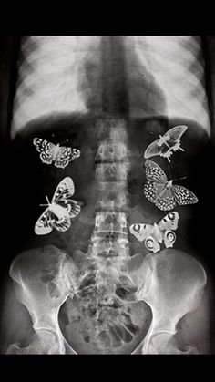 an x - ray shows the chest with butterflies on it and in the middle of the chest