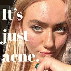 This beauty @iz.beyondthesurface has some incredible posts about her skincare journey and we love her! We wanted to share her #acnepositivity with you as she is quite fabulous! 💛 There is no such thing as 'perfect skin' and we constantly want to celebrate #realskin with its glorious textures and imperfections. Perfection is a myth, #realskin is far more beautiful🙌🏻 Cystic Acne Remedies, About Skincare, Bad Acne