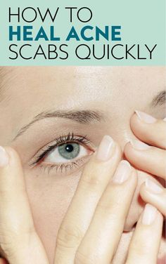 Popped a pimple and dealing with the aftermath of the scab it leaves behind? Find out how to get rid of acne scabs fast with tips from dermatologists. Scab On Face, Scab Healing, Acne Scab, Get Rid Of Acne, Rid Of Acne, Cat Eye Makeup, How To Get Rid Of Acne, Fall Makeup, Skin Tips