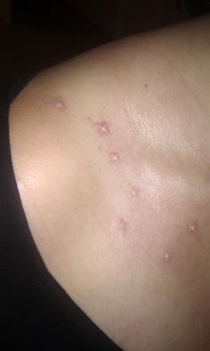 the back of a woman's shoulder with acne on it