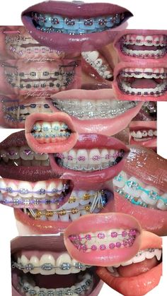 Powerchain Braces Color, Orange Braces, Braces Aesthetic, Dental Braces Colors, Braces Colors Ideas