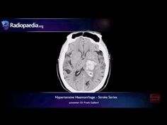 An intracerebral haemorrhage, or intraparenchymal cerebral haemorrhage, is a subset of an intracranial haemorrhage. This can encompass a number of entities that share the acute accumulation of blood in the parenchyma of the brain. The aetiology, ... Brain Imaging, Intracranial Hemorrhage, Forensic Pathology, Basal Ganglia, Brain System, Brain Images, George Carlin, X Rays