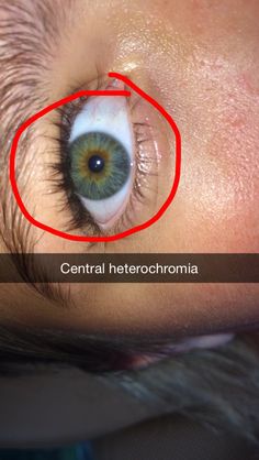 Central Heterochromia Eyes, Different Types Of Heterochromia, Heterochromia In One Eye, Centralized Heterochromia, Central Heterochromia Eyes Hazel, Sectoral Heterochromia, Sectoral Heterochromia Green, Central Heterochromia, Central Heterochromia Eyes Green Brown