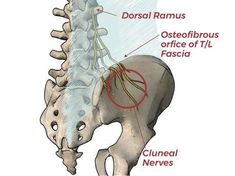 Maigne Syndrome: Sciatica of the Thoraco-Lumbar Junction — ChiroUp Sacral Plexus, Passive Stretching, Femoral Nerve, Median Nerve, Lumbar Disc, Referred Pain, Disk Herniation, Subcutaneous Tissue, Peripheral Nerve