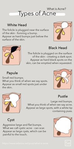 Papules Acne, Head Acne, Different Types Of Acne, Blind Pimple, Pimples Under The Skin, Tips For Oily Skin, Oily Skin Acne