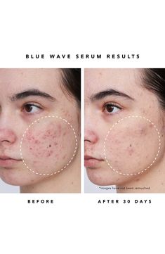 What it is: A clean acne serum that clears and dries up acne blemishes, blackheads and whiteheads with maximum-strength OTC power (2% salicylic acid).Who it's for: Ideal for acne-prone, oily or combination skin.What it does: Plant-derived blue tansy, willow bark, aloe and bisabolol replenish and soothe the skin's barrier and provide hydration. How to use: Apply the treatment serum to clean dry skin on areas of concern twice daily. 1 oz. Natural Beauty & Wellness products are free of sulfates, ph Pimples On Face, Acne Face Mask, Herbivore Botanicals, Salicylic Acid Acne, Dry Winter Skin, Blue Tansy, Acne Serum, Willow Bark, Winter Skin Care