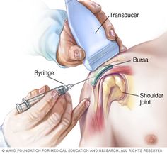 Bursitis Hip, Interventional Radiology, Rotator Cuff, Medical Anatomy, Medical Coding, Mayo Clinic, Medical Education