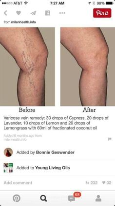 Essential Oil For Circulation, Varicose Veins Essential Oils, Varicose Vein Remedy, Essential Oil Remedy, Young Living Essential Oils Recipes, Essential Oils Guide, Essential Oils Health, Yl Essential Oils