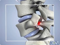 Spondylolisthesis - bone at red mark breaks and lower vertebrae shifts forward and out of alignment with vertebrae above and below, pinching the spinal nerve. Hip Health, Osteopathic Medicine, Spine Care, Arthritic Pain, Disk Herniation