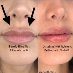 Dermal Fillers Lips, Face Fillers, Facial Fillers, Cosmetic Injectables, Cosmetic Dermatology