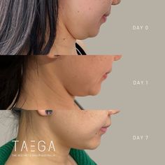 Taega's Lemon Bottle fat dissolving solution is a revolutionary injectable compound. No down time and results can be seen as fast as 24 hours! Lemon Bottle Fat Dissolving, Botox Aesthetic, Chin Reduction, Beauty Redefined, Post Inflammatory Hyperpigmentation, Platelet Rich Plasma, Facial Tattoos