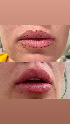 Hyaluronic Pen Before After, Hyaluron Pen Filler Before And After, Hyaluronic Pen, Lash Aesthetic, Aesthetic Boutique, Summerlin Las Vegas, Dermal Fillers Lips