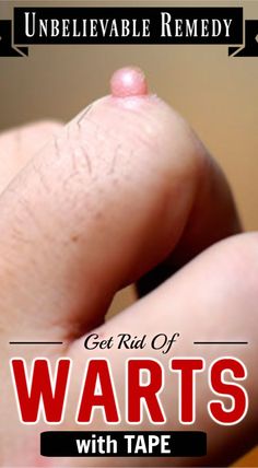 Coldsore Remedies Quick, Warts On Face, Home Remedy For Cough, Cold Sores Remedies, Natural Health Care, Natural Cold Remedies, Cold Home Remedies