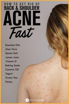 Back acne is a common skin condition that can cause pain and embarrassment. Fortunately, you can use simple home remedies to treat it and tips to prevent it. Shoulder Acne, Baking Soda Coconut Oil, Back Acne Remedies, Back Acne, Natural Acne, Body Acne, Baking Soda Shampoo, Acne Remedies