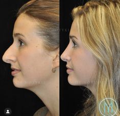 Nose Tip Surgery Before After, Nose Jobs Before And After, Nose Job Before And After Rhinoplasty, Nosejob Rhinoplasty Before After, Plastic Surgery Before And After, Rhinoplasty Before After, Nose Job Before And After, Nose Job Inspo, Before And After Nose Job