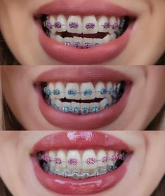 Brackets Aesthetic, Perfect Teeth Braces, Dental Braces Colors, Braces Colors Combinations, Braces And Glasses, Braces Smile, Logo Design Women, Dental Jewelry