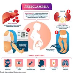 the stages of preclamipsia and how to use them in this diagram