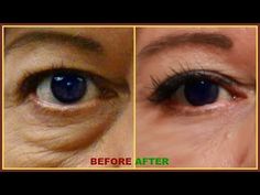 Saggy Eyes, Face Wrinkles Remedies, Baggy Eyes, Dry Under Eyes