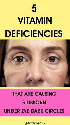 What deficiencies causes under eye dark circles ? This question is answered by a pharmacist to ensure your diet is optimised to reduce dark circles fast How To Conceal Dark Circles Under Eyes, How To Conceal Dark Circles, Remove Eye Wrinkles, Under Eye Dark Circles, Eye Dark Circles, Conceal Dark Circles, Dark Under Eye Circles, Dark Circle Remedies, Diy Wrinkles