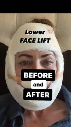 Lower Face Lift, Celebrity Surgery, Plastic Surgery Fail, Tips For Glowing Skin, Plastic Surgery Gone Wrong, Celebrity Plastic Surgery, Hair And Makeup Tips, Beauty Tips For Glowing Skin, For Glowing Skin