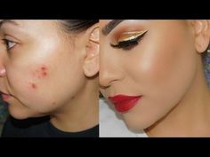 How to Cover Acne & Scars with Makeup ! Cystic Acne & Acne Scars ! - YouTube Scab On Face, Acne With Makeup, Severe Acne Remedies, Acne Scar Diy, Covering Acne, Cystic Acne Remedies, Acne Makeup, Coconut Oil For Acne, Acne Scarring