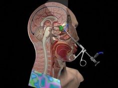 3 years post endoscopic sinus surgery. Is it worth it? I will discuss the long-term surgery outcome in this video. Dr Sleep, Mental Health Crisis, The Dating Divas