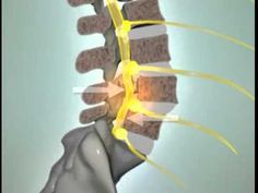 Spondylolisthesis - great video showing how the bones crack and shift, pinching the nerve. Looks painful ... and it is. Stenosis Exercises, Chiropractic Care, Chiropractic