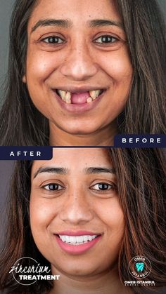 Zirconium Crown Dental Treatment - Dental Before After - Omer Istanbul Dental Center Emax Crowns, Dental Cavities, Loose Tooth, Tooth Sensitivity, Stronger Teeth, Dental Crowns, How To Prevent Cavities