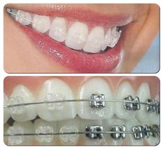 Braquet Braces Care, Invisalign Braces, Braces Tips, Color