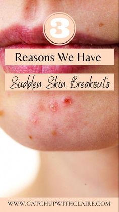 Sudden spot breakouts can be an embarrassing issue to deal with. I have 3 reasons why you might be suffering and what to do about it Blemishes On Face Remedies, Face Breakout Remedies, Breakout Remedies, Skin Breakouts, Spots On Face