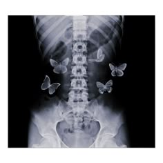 an x - ray shows butterflies flying around the neck