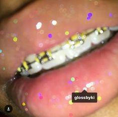 Braces Aesthetic, Braces Colours, Dental Braces Colors, Braces Ideas, 2000s Theme, Braces Tips, Getting Braces