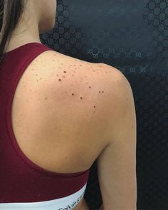 a woman with acne on her back