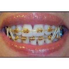 Smile With Braces, Natural Teeth Whitening Diy, Invisible Braces