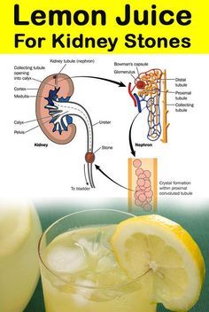 Kidney Stone Diet, Oxalate Diet, Kidney Stone, Chronic Kidney, Health Heal, Kidney Health, Outlet Store, Health Info