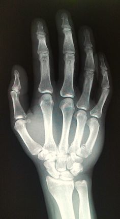 an x - ray image of the hand and wrist