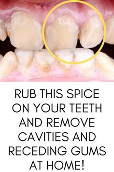 Home Remedies For Cavities, Tooth Decay Remedies, Remedies For Tooth Ache, Dental Cavities, The Teeth, Oral Care Routine, Gum Care