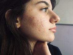 Acne Appreciation, Acne Positive, Skin Positivity, Home Remedies For Pimples, Pimples Overnight, Scaly Skin