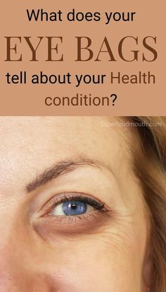 Eye bags are the common beauty issues found in a massive number of people. Well, we are not born with such surreal eyebags. There are many causes for the formation of eye bags but the primary cause will be Ageing. As we age we tend to diagnose many strange beauty problems. However, there is a remedy Different Types Of Eyes, Swollen Eyes, Eye Sight Improvement, Under Eye Puffiness, Types Of Eyes, Vision Problems, Hygiene Routine, Healthy Eyes