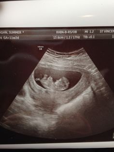 an x - ray image of a woman's breast is shown on the monitor screen